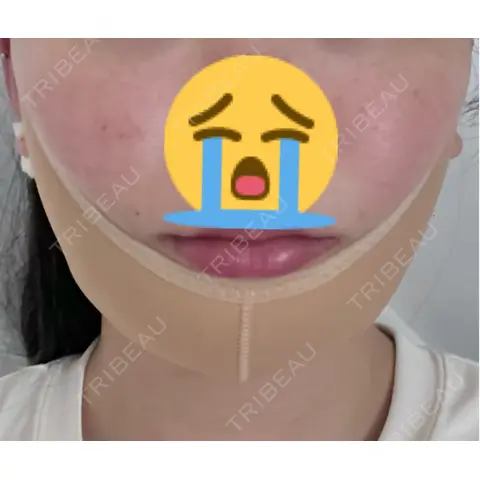 脂肪吸引注射（顔） MIL CLINIC OSAKA DAY 0