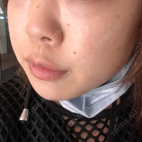 エレクトロポレーション / ルメッカ B-LINE CLINIC 池袋院 DAY 0
