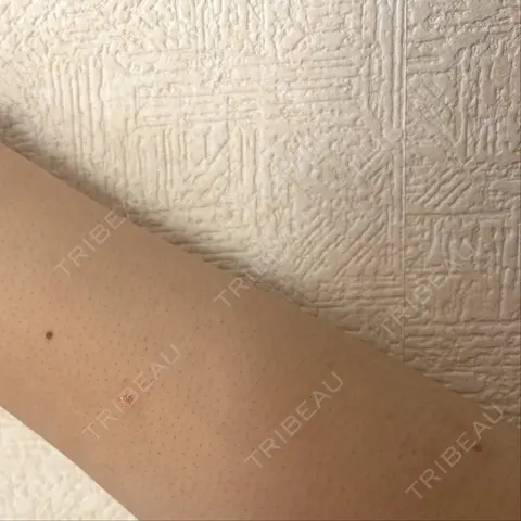 ほくろ・いぼ除去レーザー（肌） Mavie Beauty Clinic （マヴィービューティークリニック） DAY 3