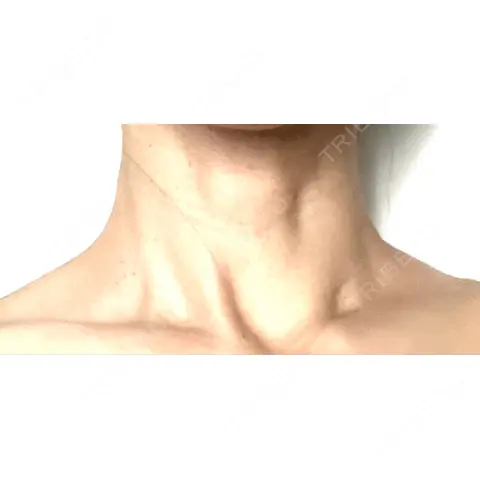 ボトックス（首） MYCLI【マイクリ】 AFTER