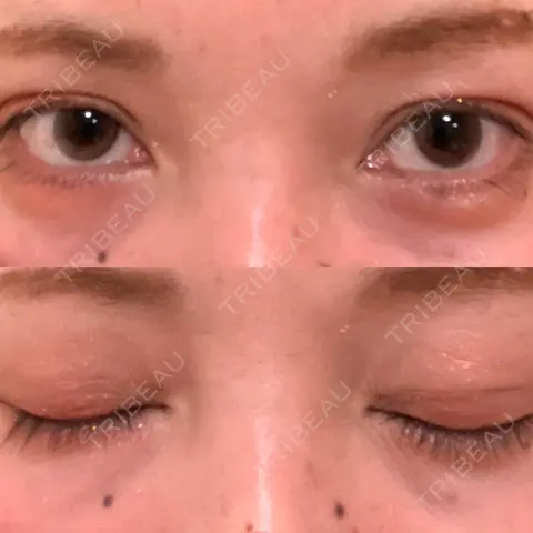 二重埋没 / ヒアルロン酸注入（涙袋） AI Beauty Clinic （エーアイ美容クリニック） AFTER