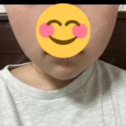 ボトックス（エラ・小顔） 共立美容外科 梅田院 AFTER