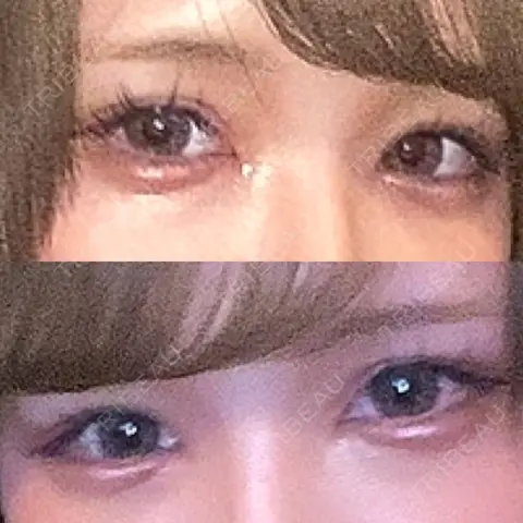 目頭切開 AI Beauty Clinic （エーアイ美容クリニック） AFTER