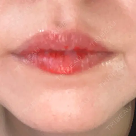 その他（口元） にしまき美容スキンクリニック AFTER
