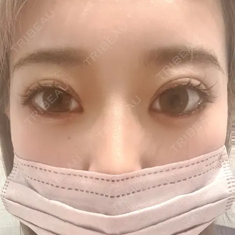 二重埋没 / 下まぶたの脂肪取り R Beauty CLINIC 名古屋院 DAY 31