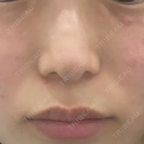 その他（肌） 美容皮膚科 デュークリニック DAY 0