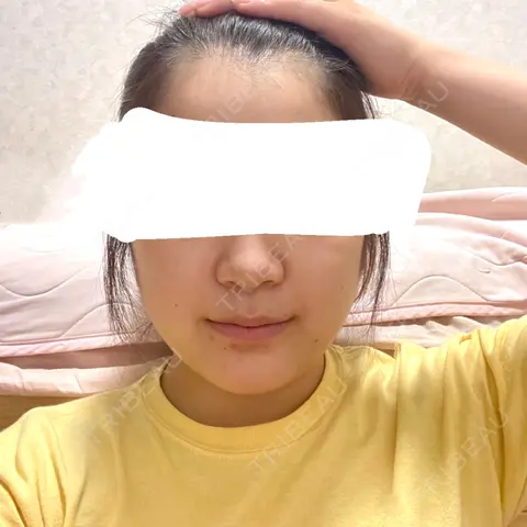 ヒアルロン酸注入（鼻翼基部） AI Beauty Clinic （エーアイ美容クリニック） AFTER