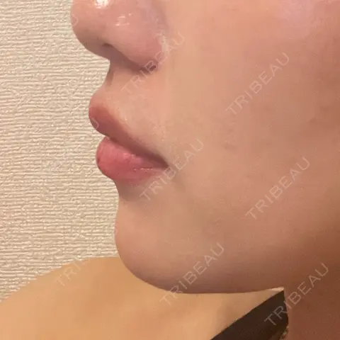 ヒアルロン酸注入（涙袋） / ヒアルロン酸注入（唇） HAAB×DREAM BEAUTY CLINIC 東京本院 DAY 1