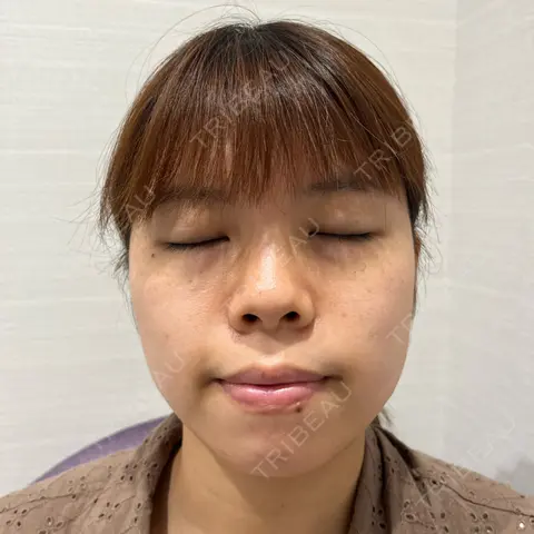 ヒアルロン酸注入（鼻） R Beauty CLINIC 名古屋院 AFTER