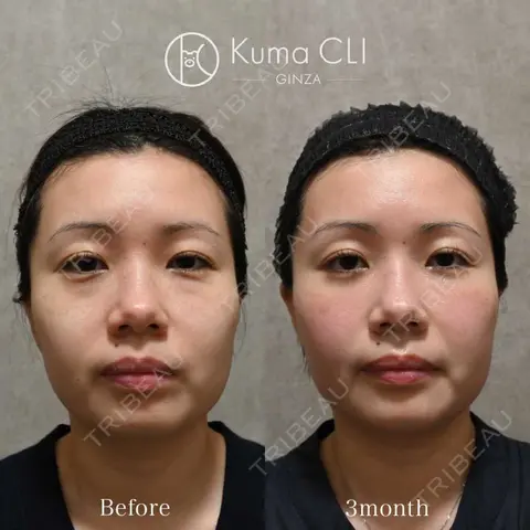 クマ治療 Kuma CLI 【クマクリ】 AFTER