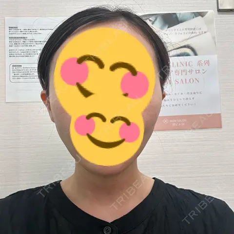 糸リフト / 脂肪吸引（顔） WOM CLINIC GINZA （ワム クリニック ギンザ） DAY 1