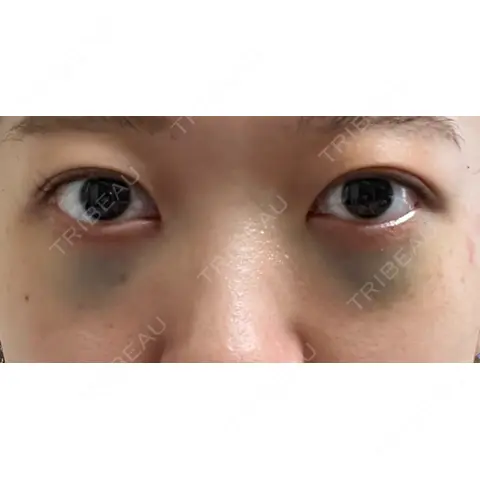 下まぶたの脂肪取り APOLLO BEAUTY CLINIC DAY 0