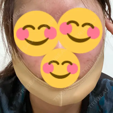 二重埋没 / バッカルファット除去 / ヒアルロン酸注入（あご） / ボトックス（エラ・小顔） アリエル美容クリニック 大宮院 DAY 1
