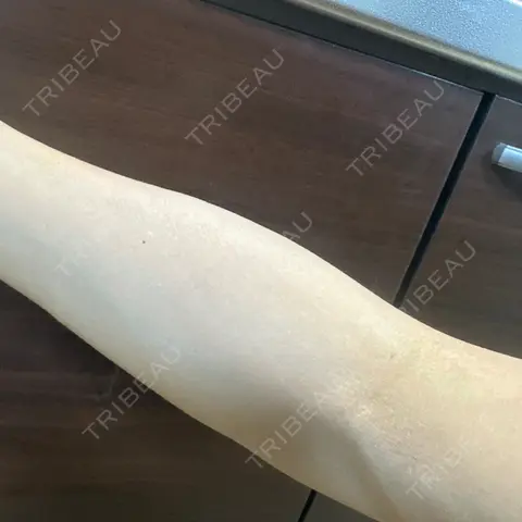 美容点滴・美容注射（美肌） / 白玉点滴・注射 新宿美容内科医療クリニック AFTER