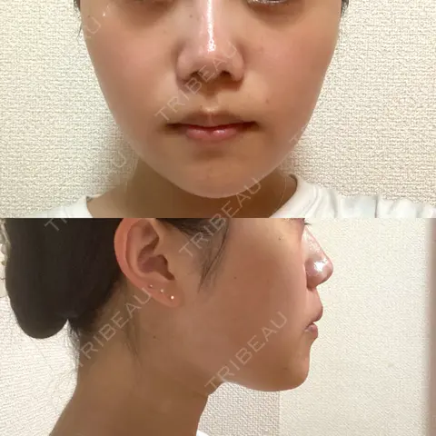 糸リフト / 脂肪吸引（顔） / ボトックス（エラ・小顔） RIVER CLINIC（リバークリニック） AFTER