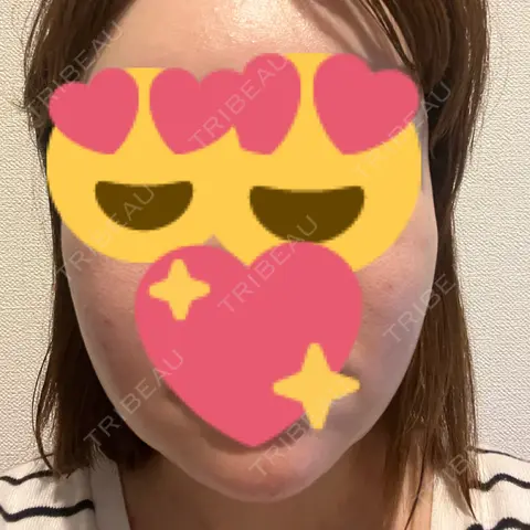 脂肪注入（輪郭） / マイクロボトックス / ボトックス（ガミースマイル） / PRP皮膚再生療法 EMMO FACE CLINIC 大宮院 DAY 1