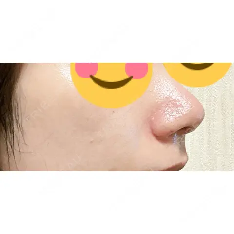 鼻尖形成（切開） / 軟骨移植 / 鼻翼挙上 / 鼻修正 / その他（鼻） 東京シンデレラ美容外科 大宮院 DAY 7