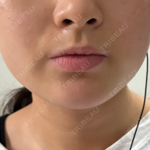 ボトックス（エラ・小顔） DMTC美容皮膚科 渋谷院 DAY 1