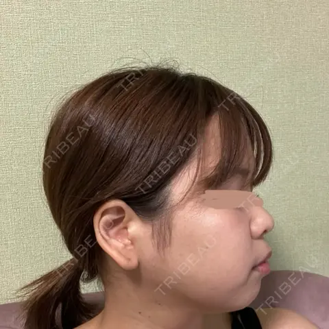 脂肪吸引（顔） R Beauty CLINIC 名古屋院 AFTER