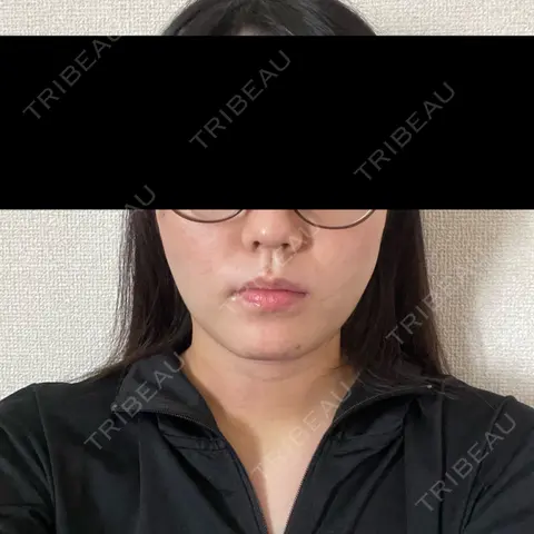 糸リフト / 脂肪吸引（顔） / ジョールファット除去 / 脂肪吸引注射（顔） SEA CLINIC（シークリニック） DAY 2