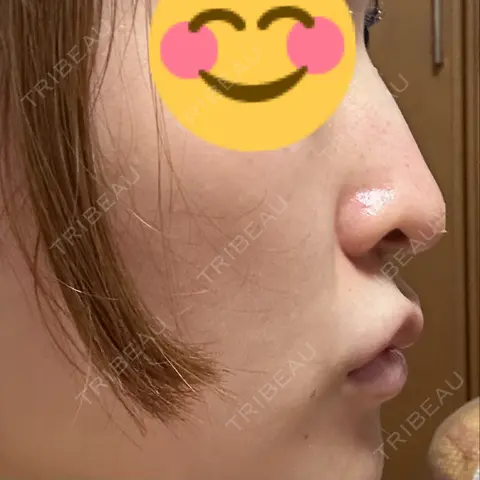 スレッドノーズ YBC横浜美容外科 立川院 DAY 1