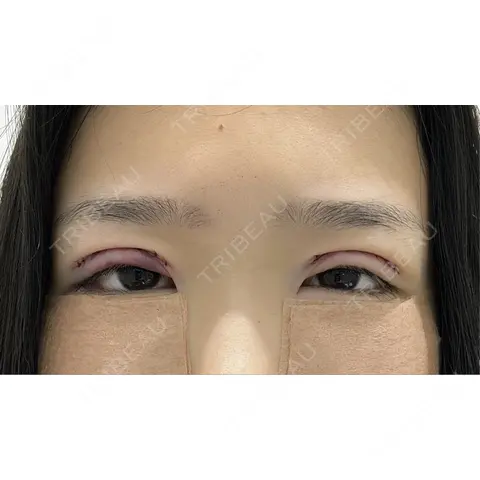 二重切開 / クマ治療 R Beauty CLINIC 銀座院 DAY 0