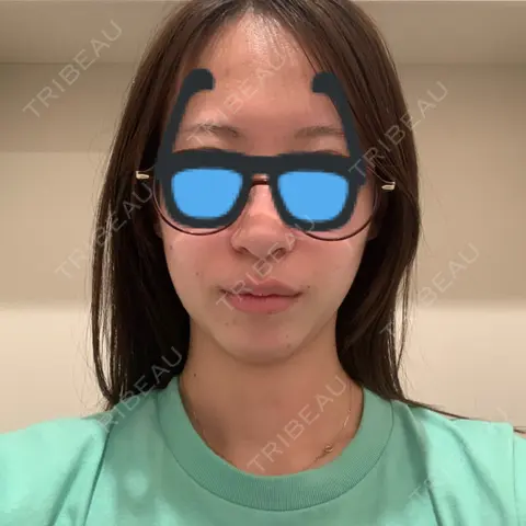 ヒアルロン酸注入（あご） HAAB×DREAM BEAUTY CLINIC 東京本院 AFTER