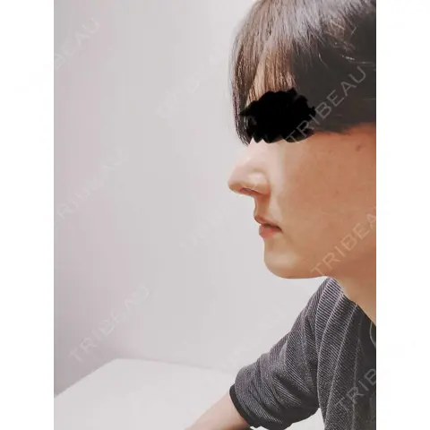 鼻修正 / 鼻尖縮小 id（アイディ）美容外科 AFTER