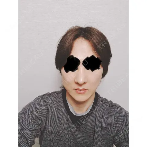 鼻修正 / 鼻尖縮小 id（アイディ）美容外科 AFTER