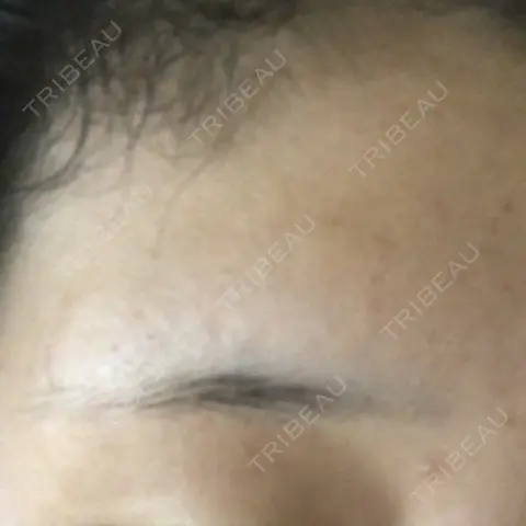 医療脱毛（顔） LIFIX BEAUTY CLINIC DAY 2