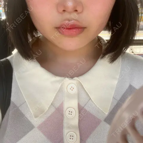 ヒアルロン酸注入（あご） / ボトックス（エラ・小顔） / 脂肪溶解注射（顔） 東京美容外科 池袋院 AFTER