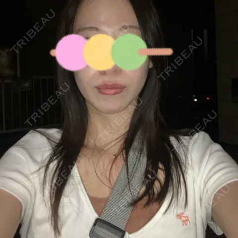 ヒアルロン酸注入（あご） HAAB×DREAM BEAUTY CLINIC 東京本院 AFTER