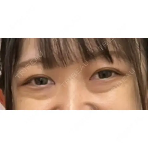 下まぶたの脂肪取り APOLLO BEAUTY CLINIC AFTER