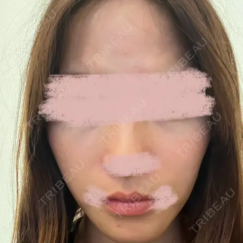 美容点滴・美容注射（美肌） 城本クリニック 福岡院 AFTER