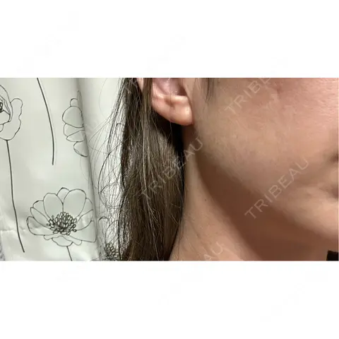 ボトックス（あご） / ボトックス（エラ・小顔） / ボトックス（眉間） / ボトックス（目尻） / その他（口元） TCB東京中央美容外科 高崎院 AFTER