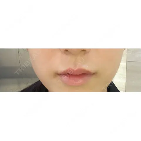 ボトックス（人中） BiBiクリニック DAY 0