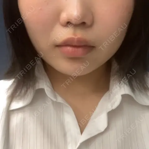 ヒアルロン酸注入（あご） / ボトックス（エラ・小顔） / 脂肪溶解注射（顔） 東京美容外科 池袋院 AFTER