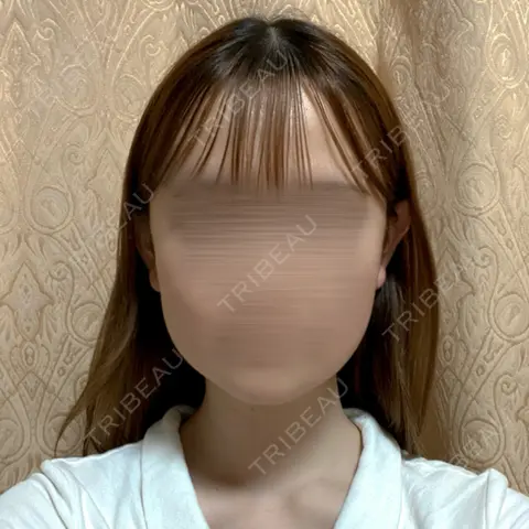 骨切り（あご） / 骨削り（エラ） / 骨削り（頬） セギム美容整形外科 DAY 31