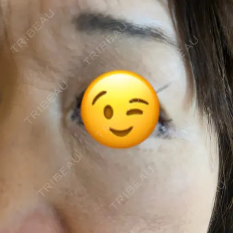 クマ治療 / ヒアルロン酸注入（目の下） / ボトックス（額） AI Beauty Clinic （エーアイ美容クリニック） AFTER