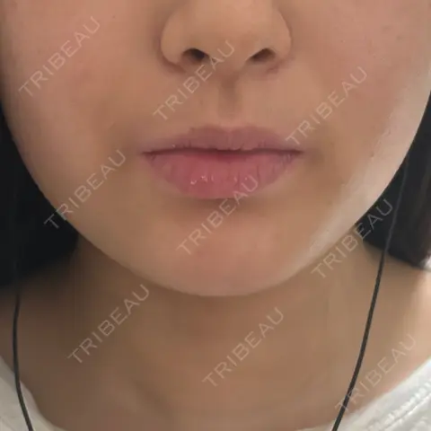 ボトックス（エラ・小顔） DMTC美容皮膚科 渋谷院 AFTER
