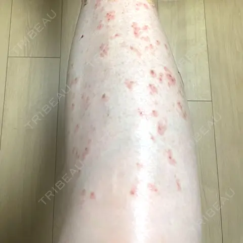 ほくろ・いぼ除去レーザー（肌） / シミ取りレーザー / ピコスポット Mavie Beauty Clinic （マヴィービューティークリニック） DAY 1