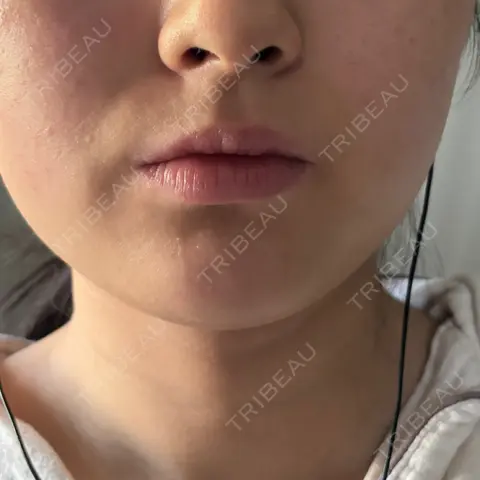 ボトックス（エラ・小顔） DMTC美容皮膚科 渋谷院 AFTER