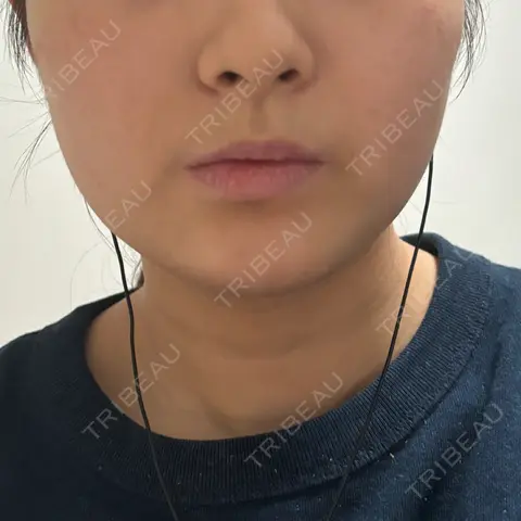ボトックス（エラ・小顔） DMTC美容皮膚科 渋谷院 AFTER