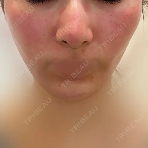 ダーマペン DAILY SKIN CLINIC 心斎橋院 DAY 0