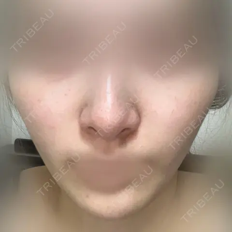 ダーマペン DAILY SKIN CLINIC 心斎橋院 AFTER