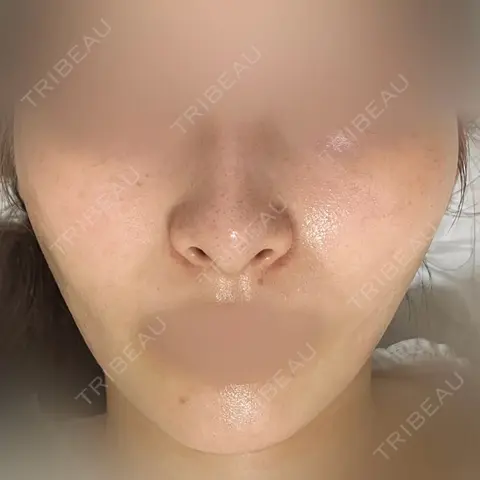 ダーマペン DAILY SKIN CLINIC 心斎橋院 AFTER