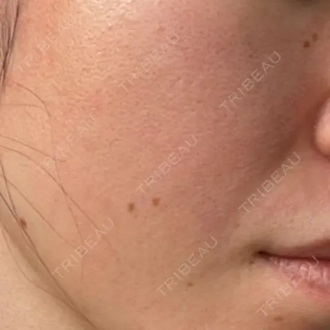 ポテンツァ ARTE SKIN CLINIC 【アルテスキンクリニック】 AFTER