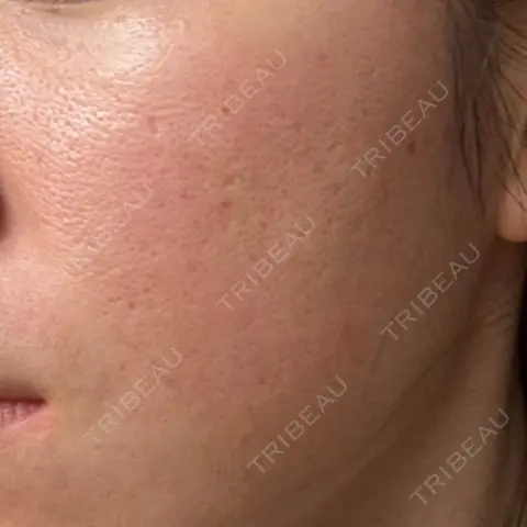 ポテンツァ ARTE SKIN CLINIC 【アルテスキンクリニック】 AFTER