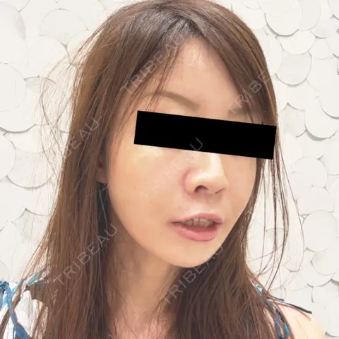 糸リフト / 脂肪注入（肌） / 脂肪注入（額） / 脂肪注入（輪郭） / その他（肌） 湘南美容クリニック Regno 銀座院 AFTER