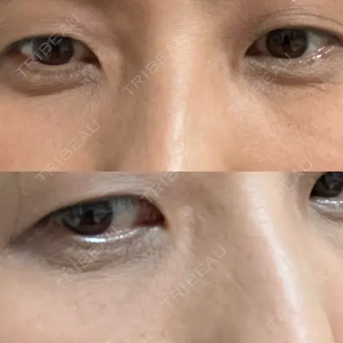 クマ治療 / 下まぶたの脂肪取り AI Beauty Clinic （エーアイ美容クリニック） AFTER
